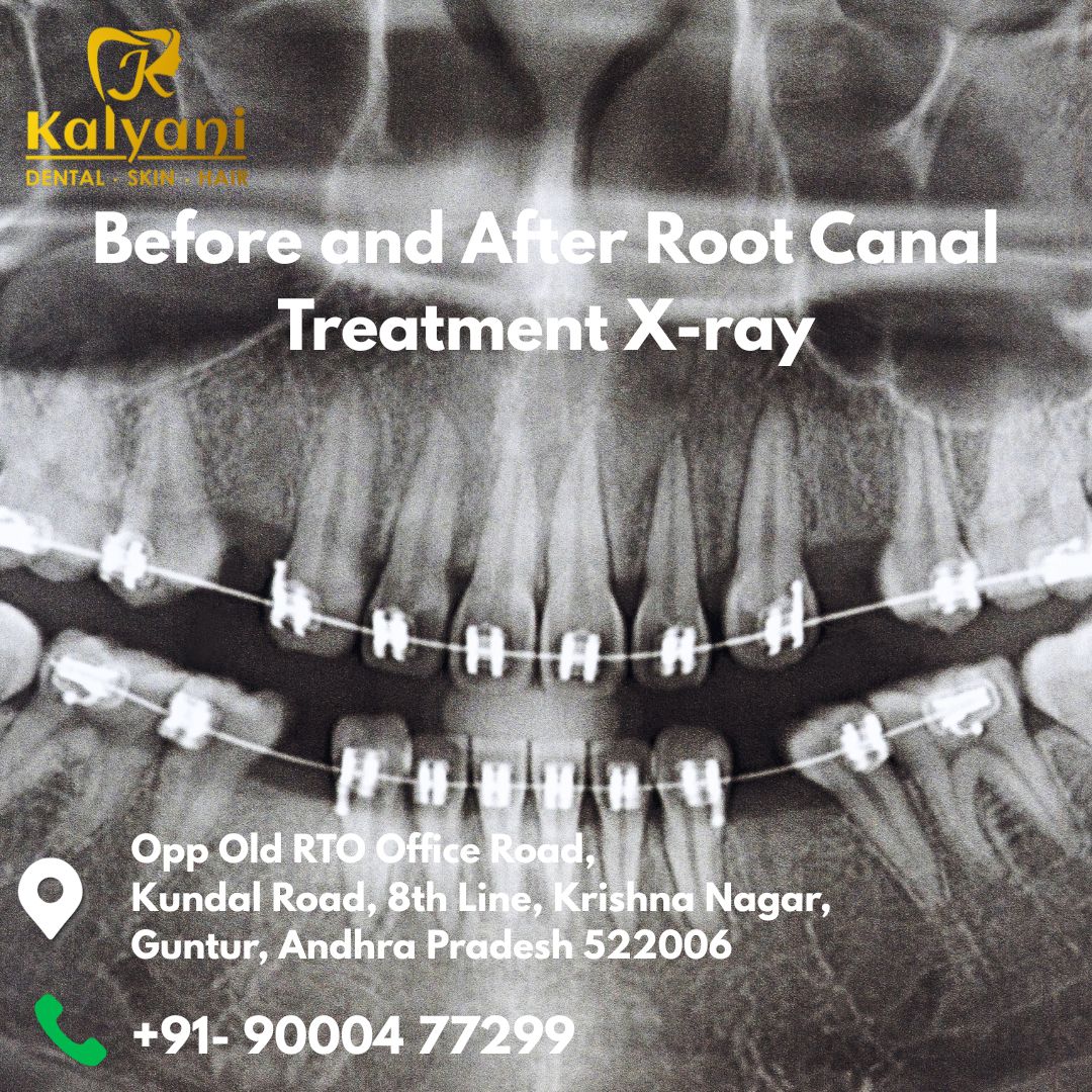 Before and After Root Canal Treatment X-ray