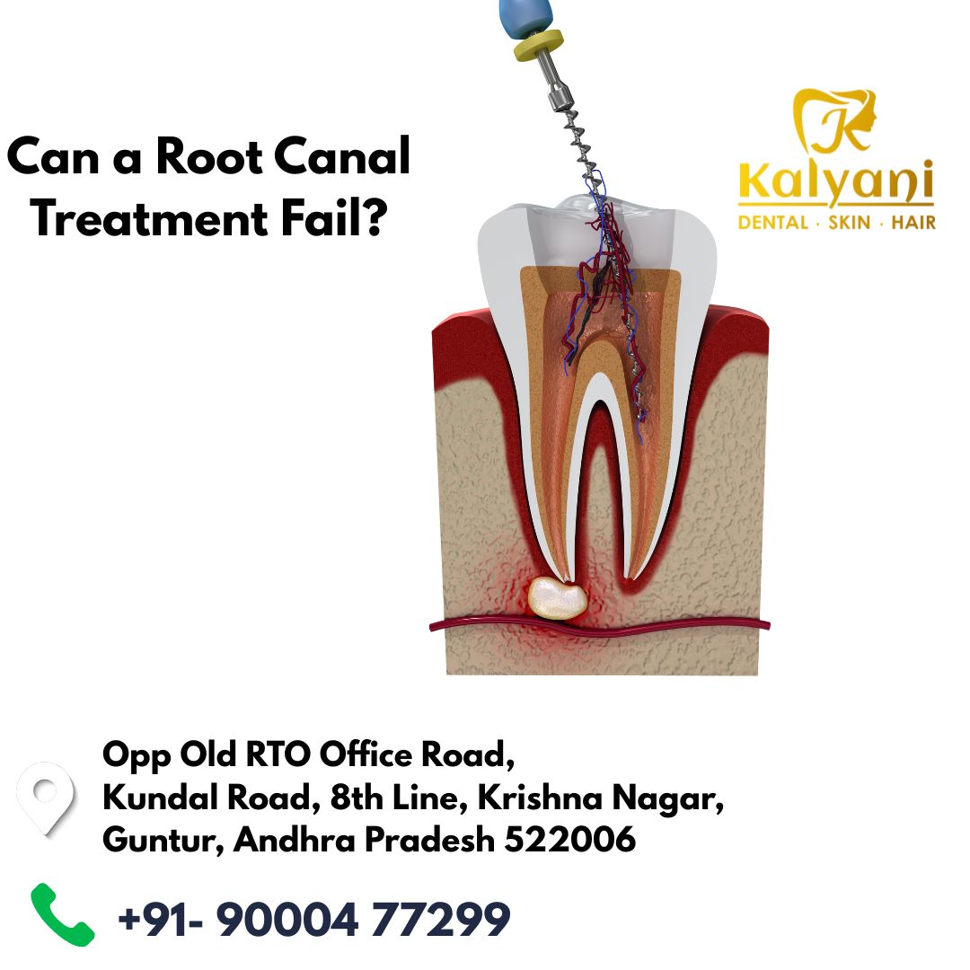 Can a Root Canal Treatment Fail? 