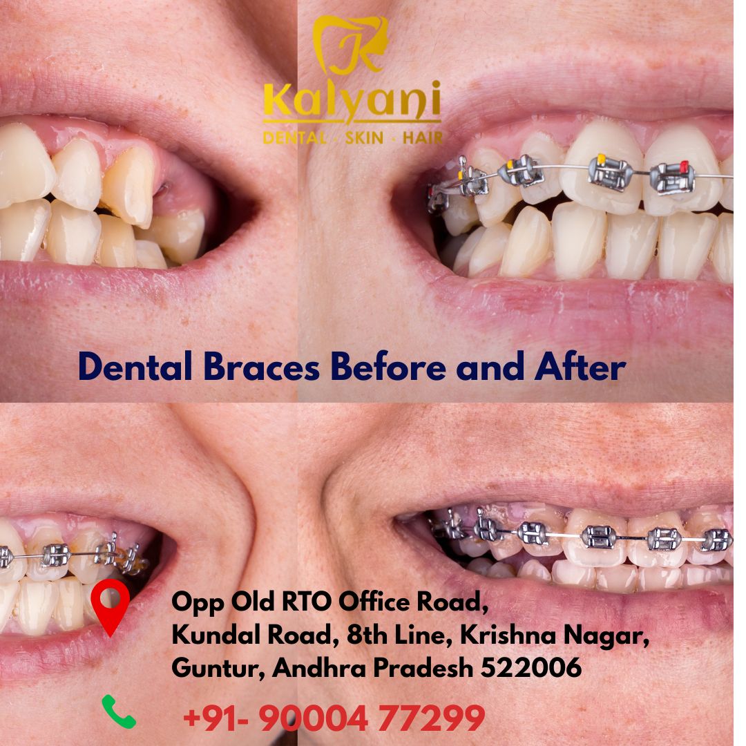 Dental Braces Before and After