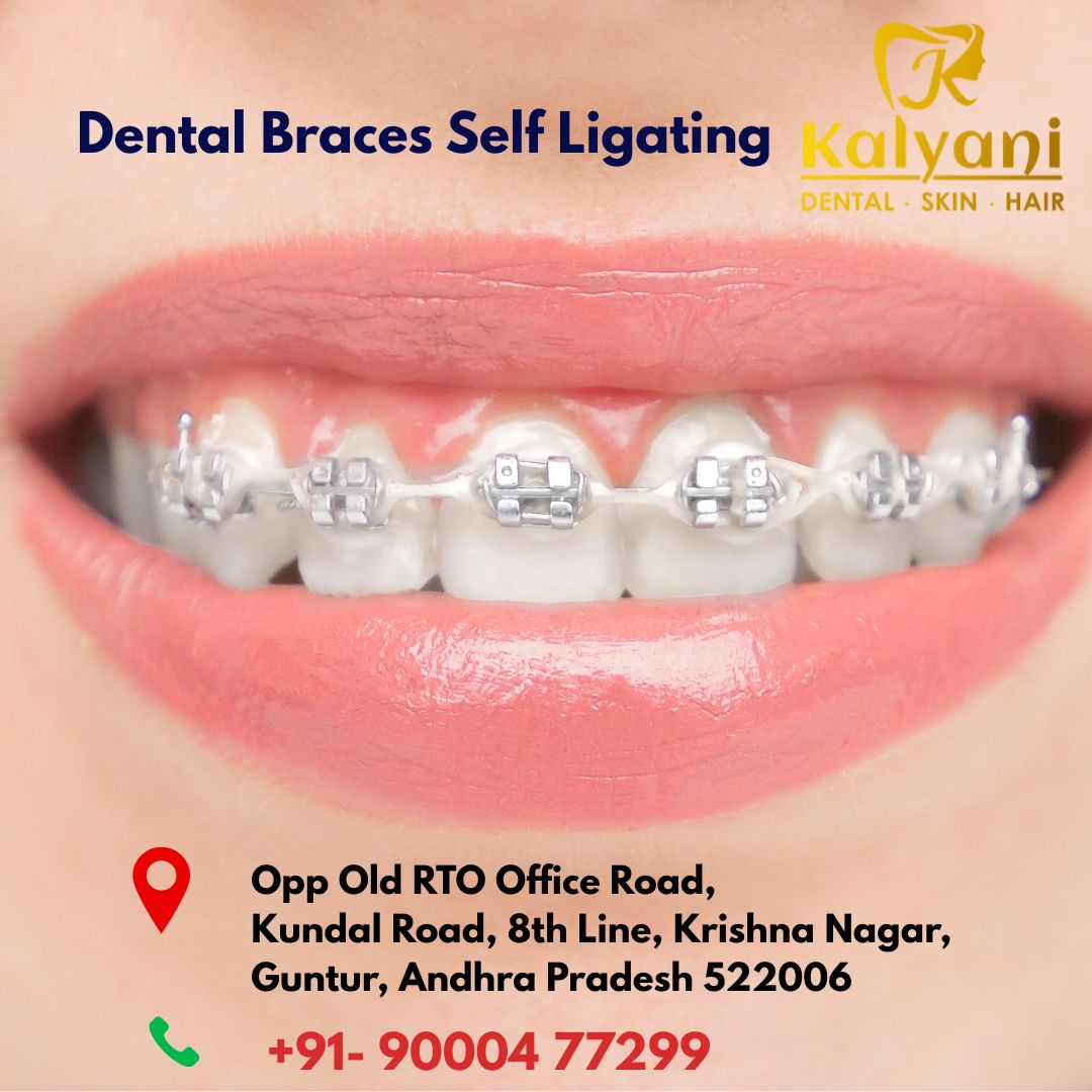 Dental Braces Self Ligating