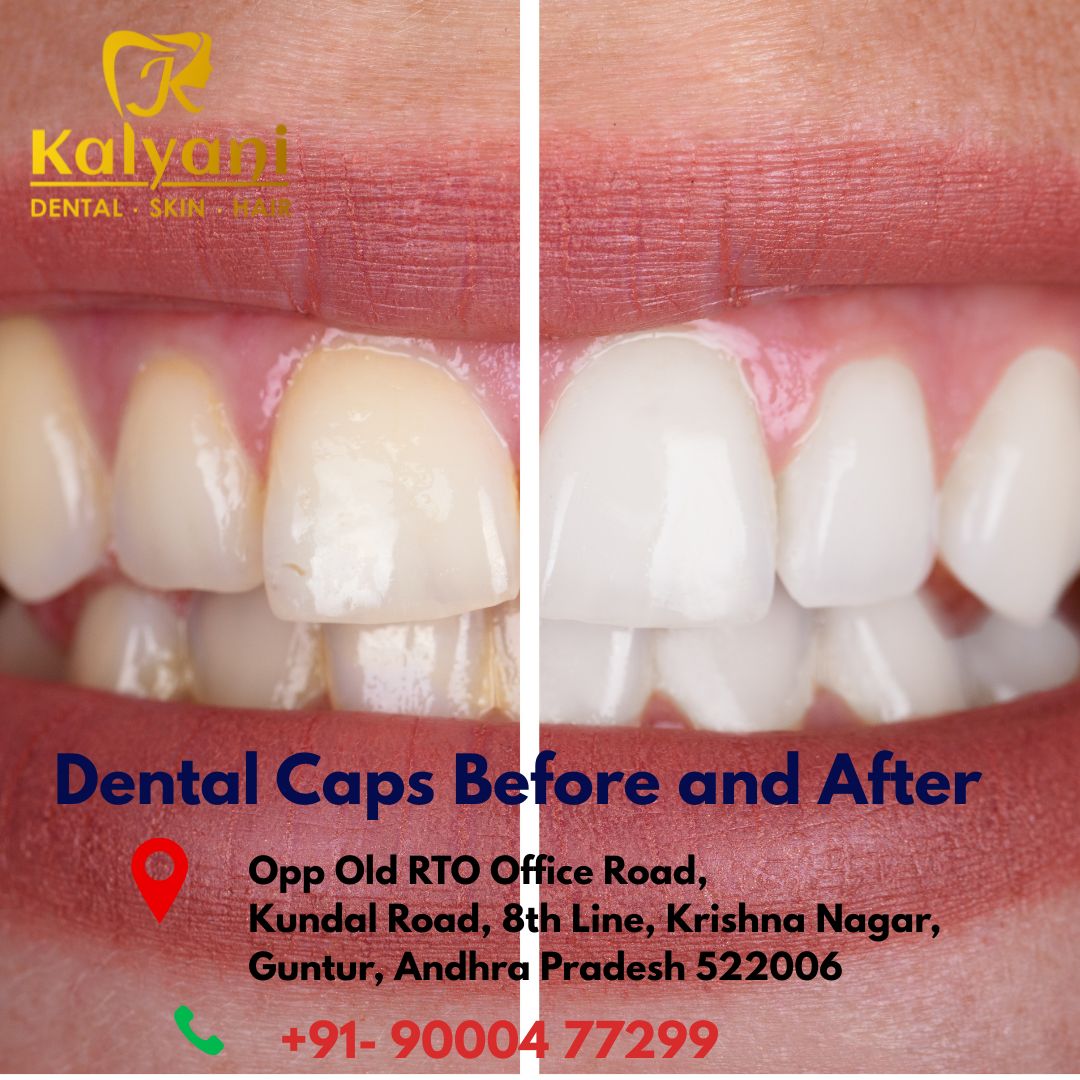 Root Canal Treatment Procedure