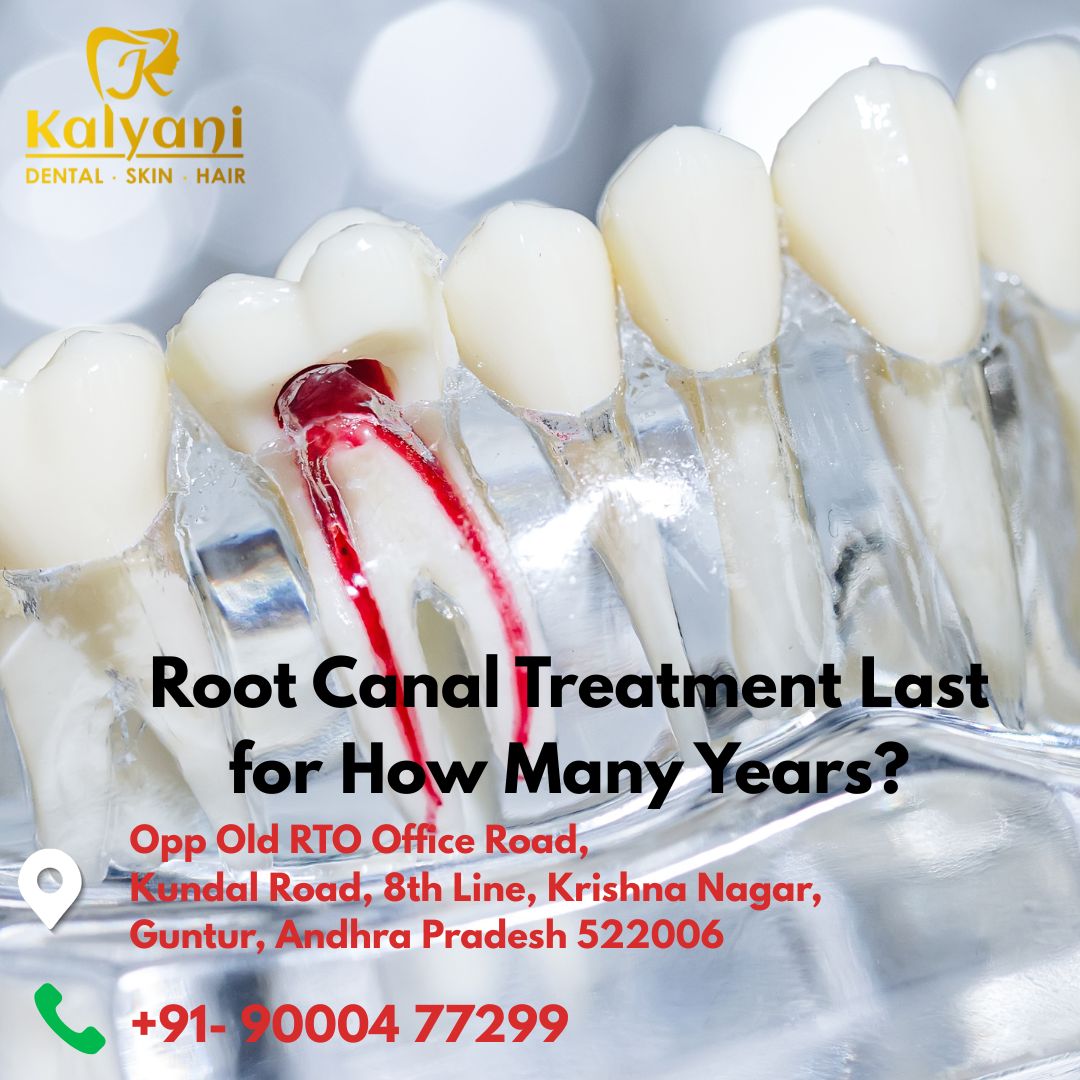 Root Canal Treatment Last for How Many Years