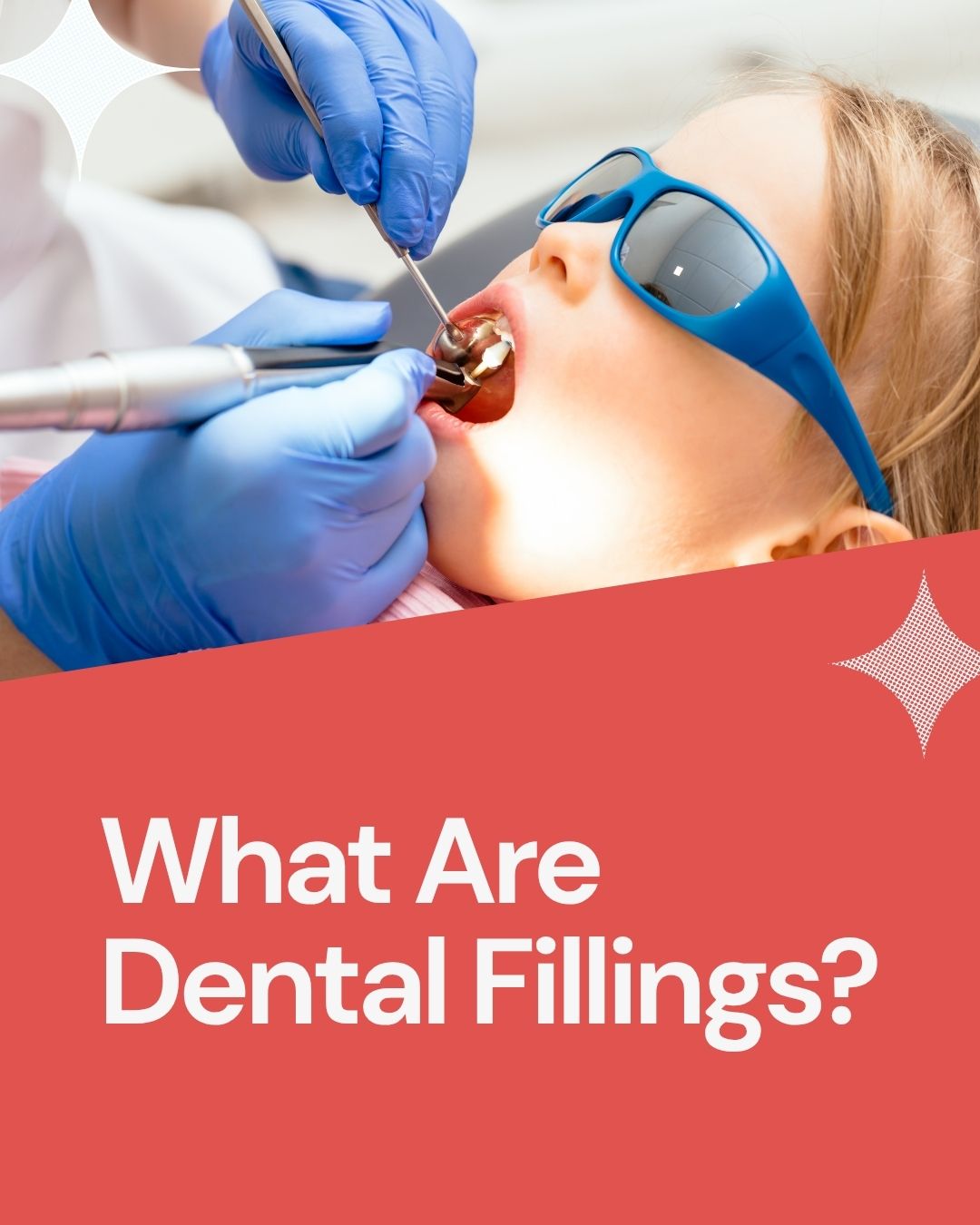what-are-dental-fillings